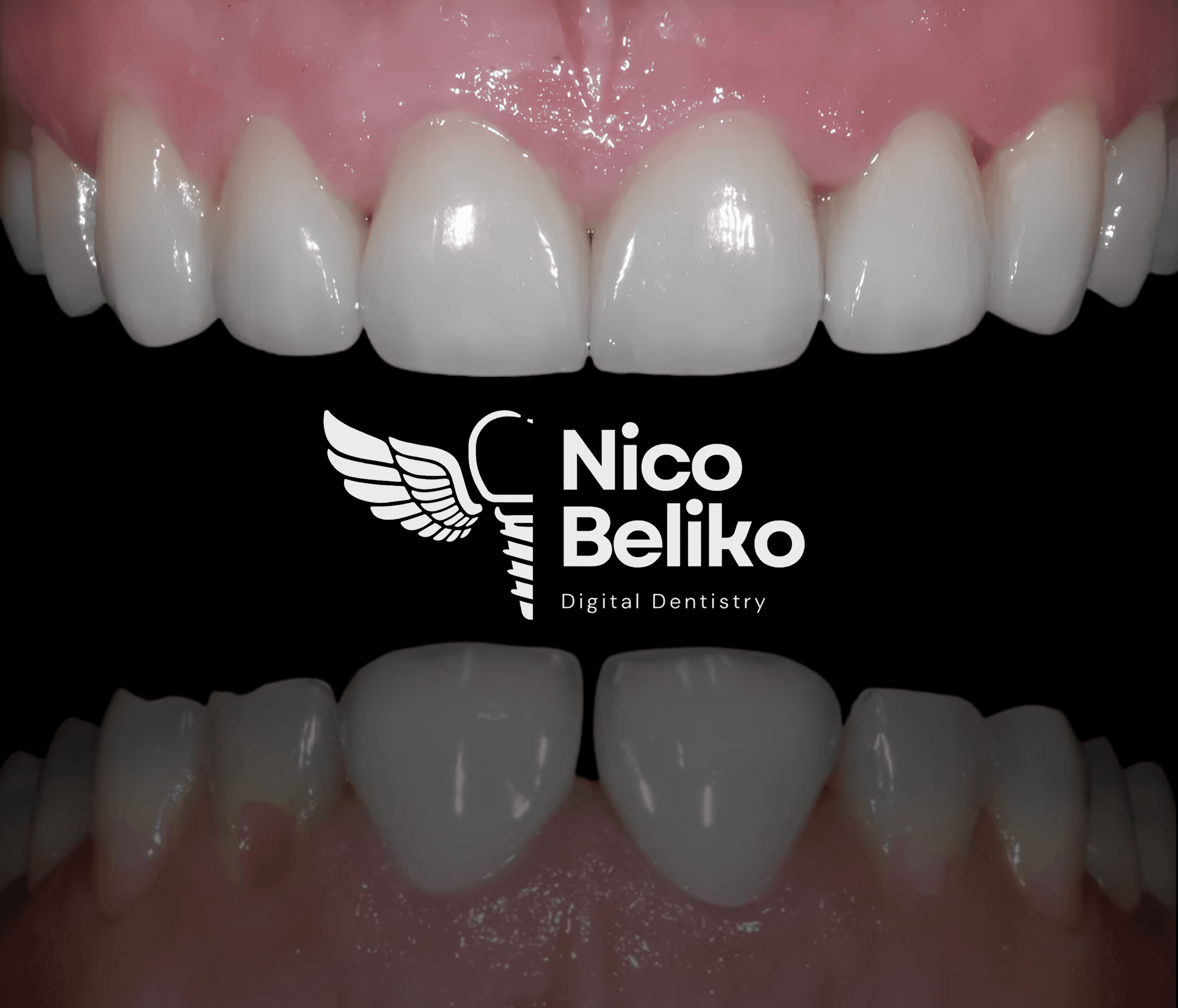 Milled zirconia crowns on a model