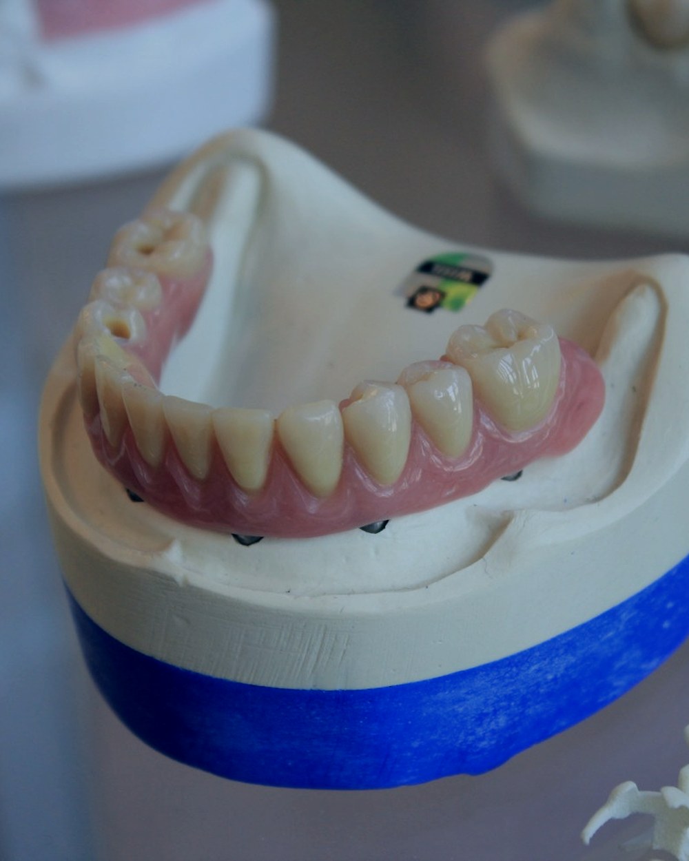 Full-arch implant overdenture on a working model