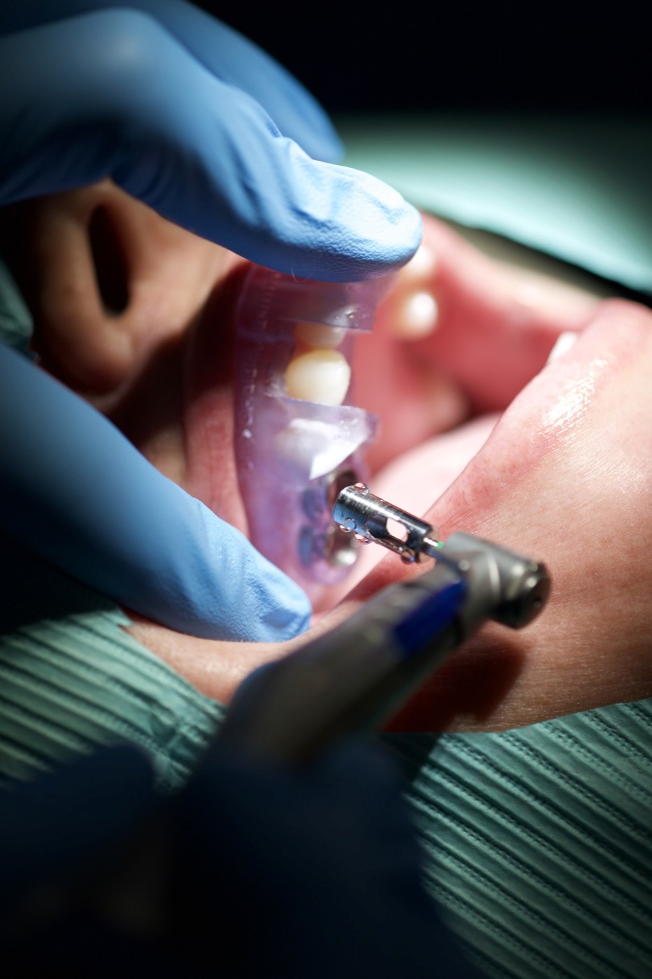 Digitally designed dental surgical guide planned in Blue Sky Plan