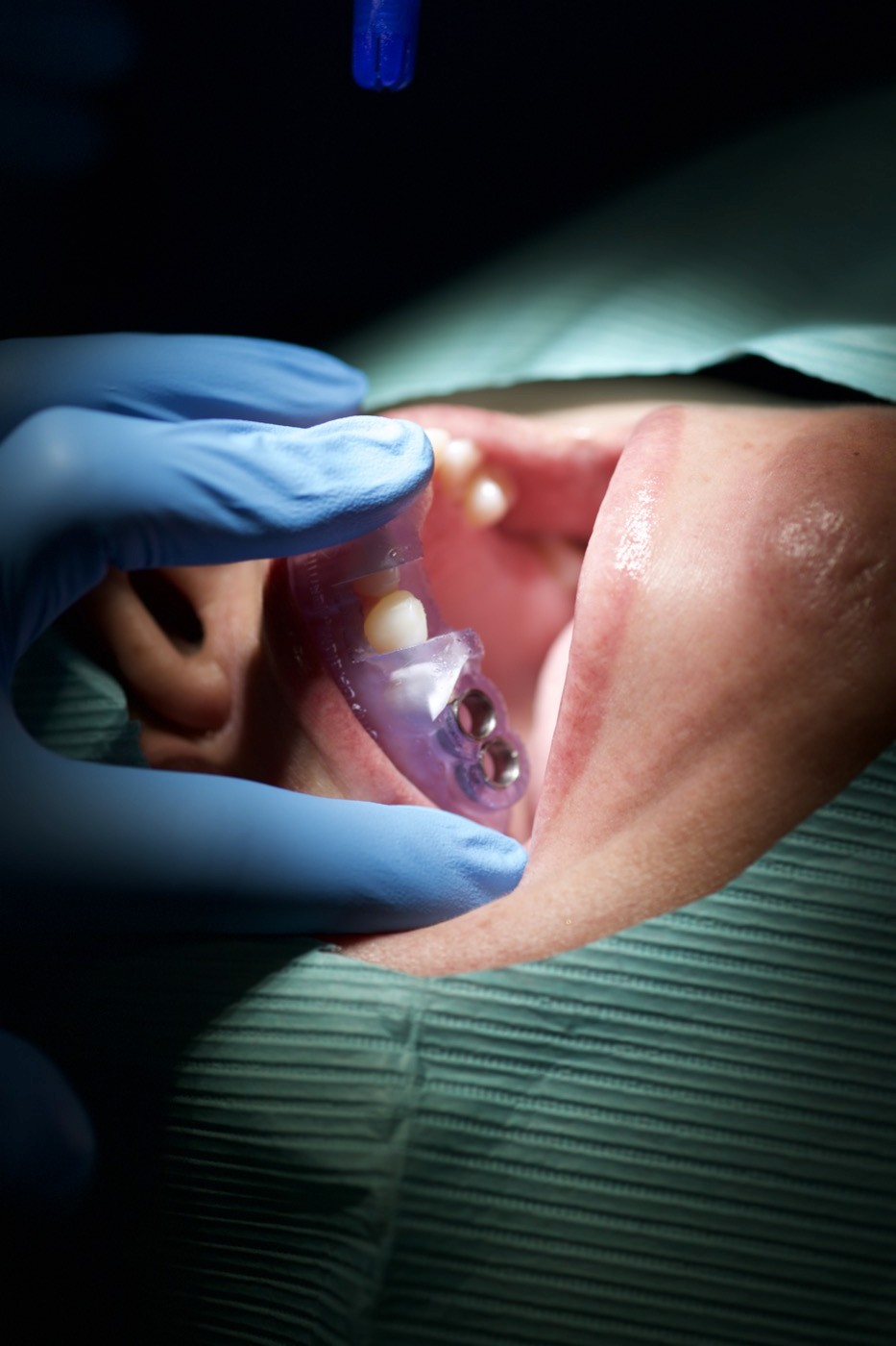 Clinician positioning a surgical guide during guided implant surgery