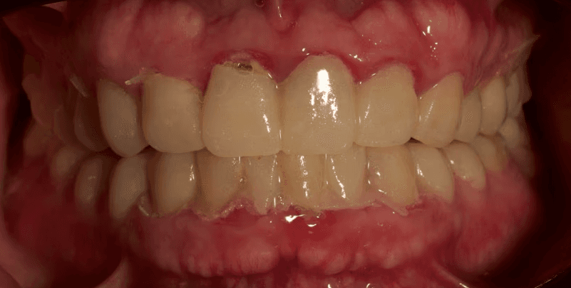 The mock-up tried in the same mouth